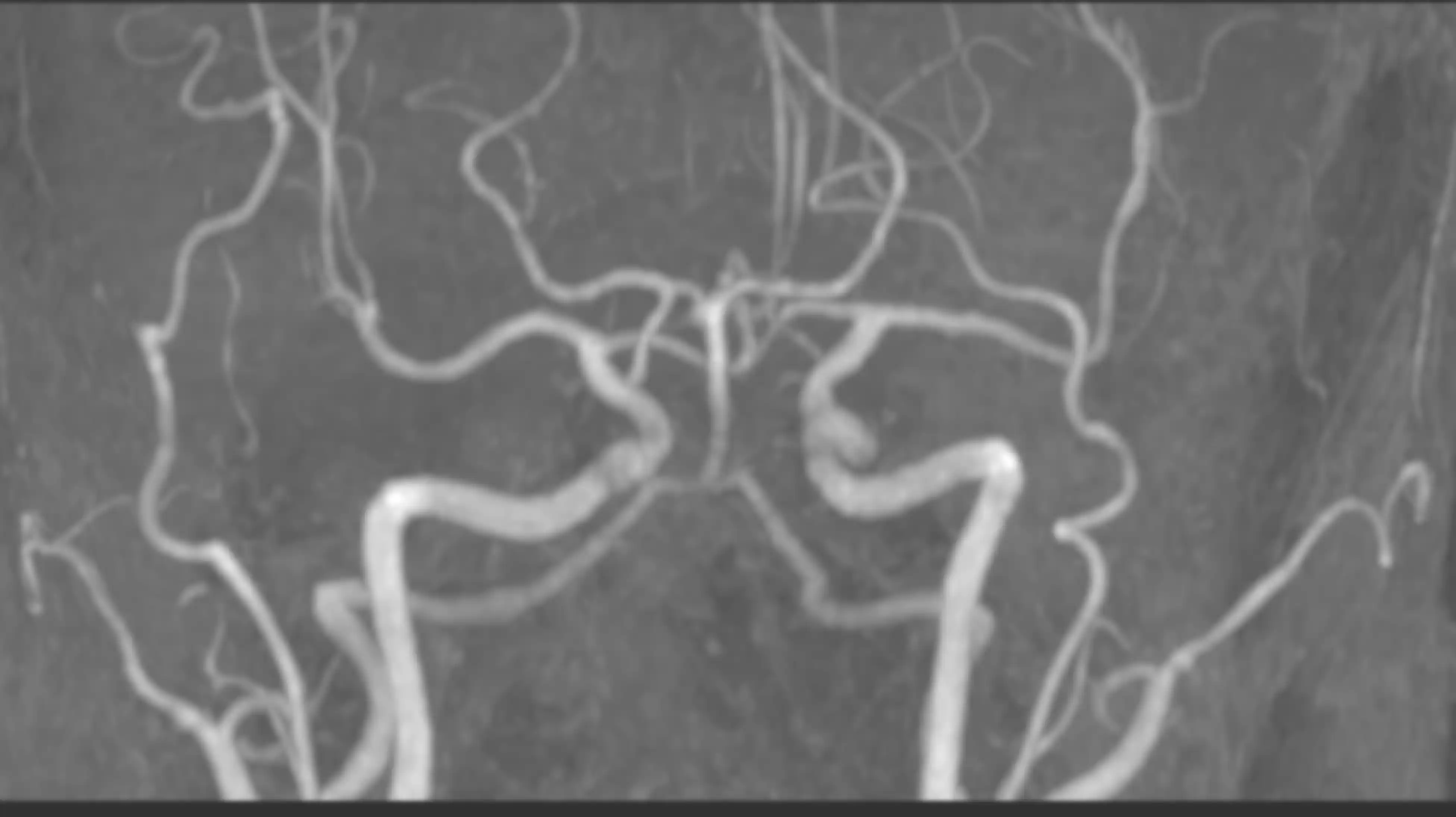 МРТ ангіографія судин голови та шиї