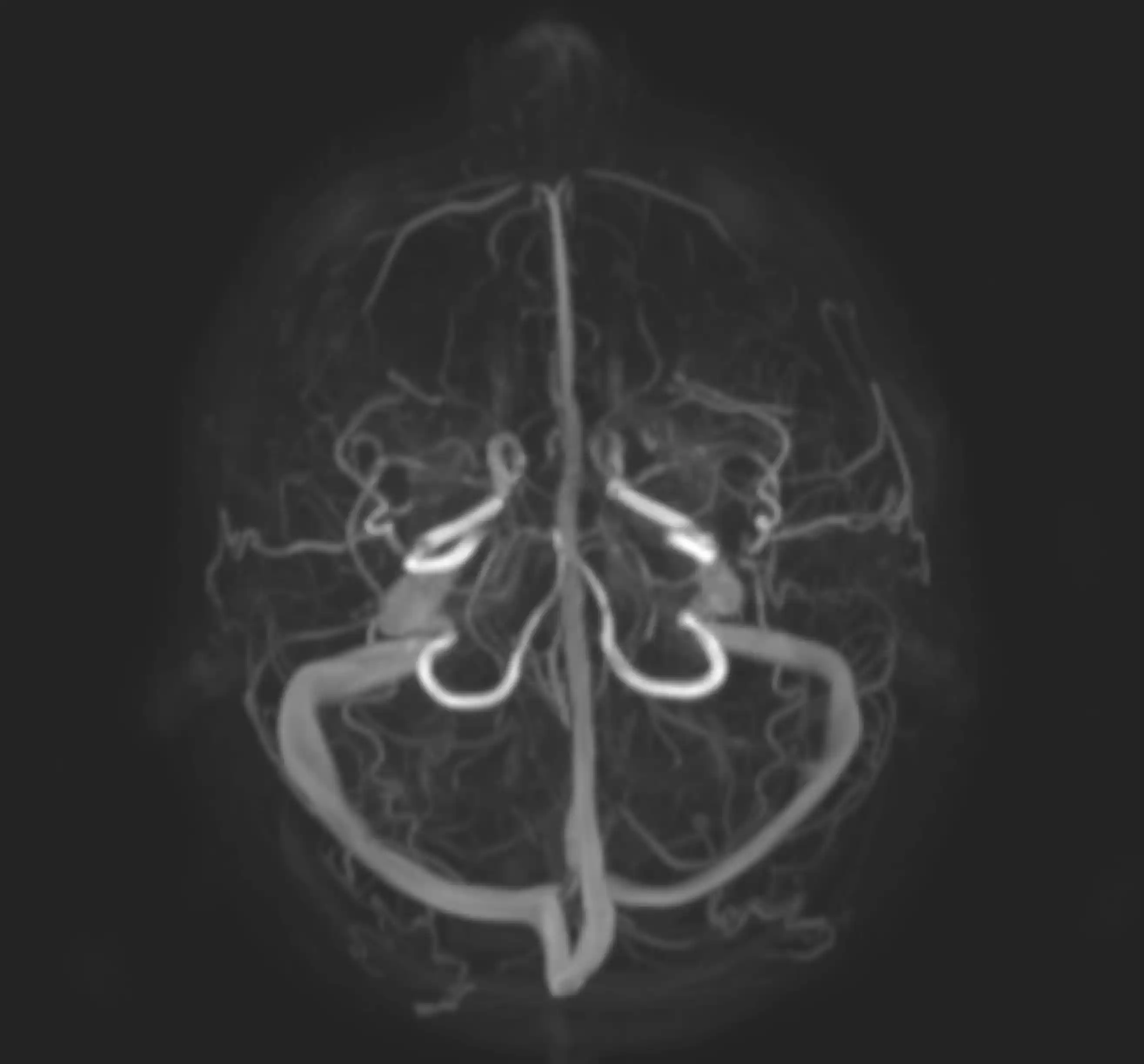 МРТ ангіографія