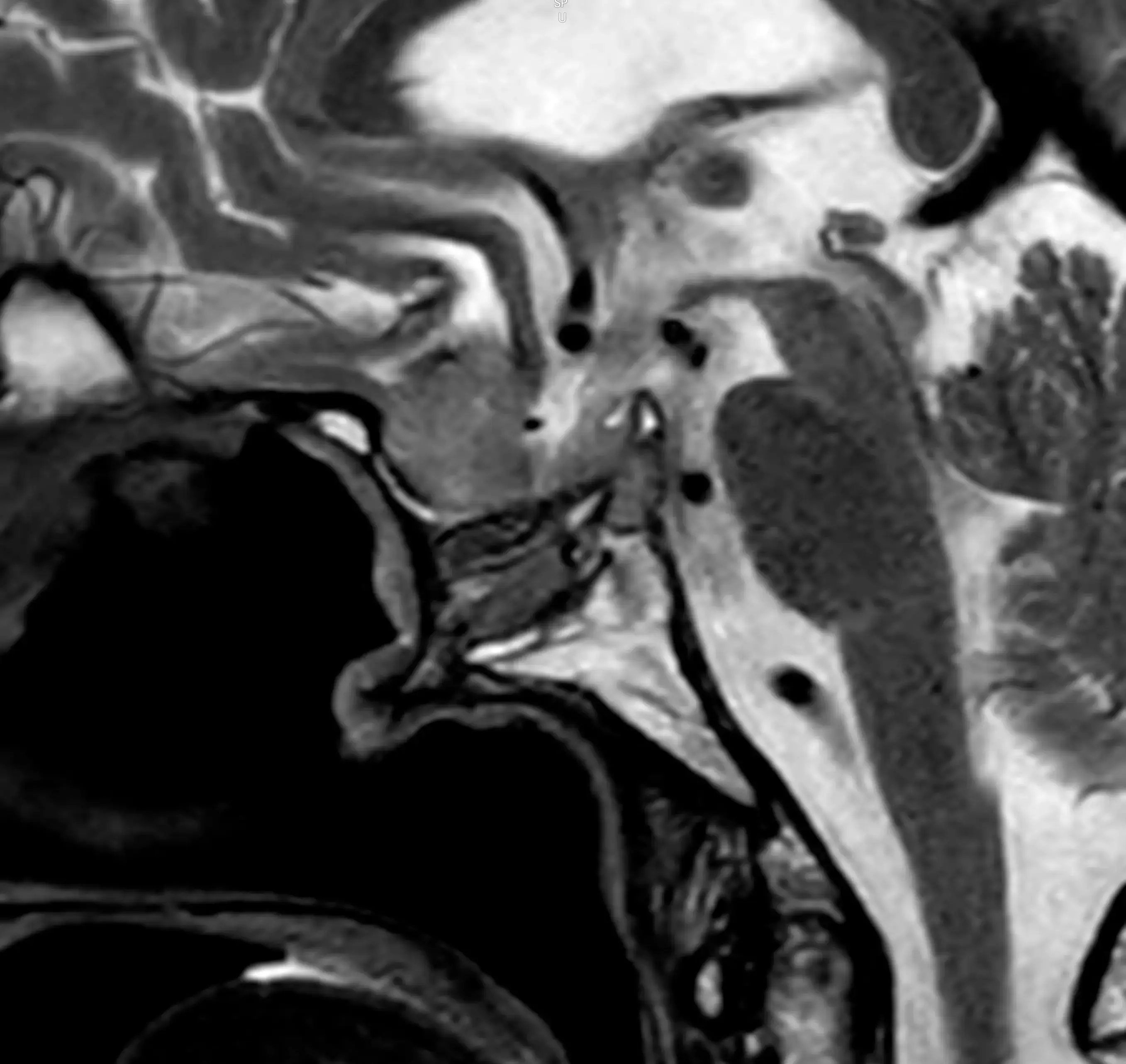 МРТ гіпофіза