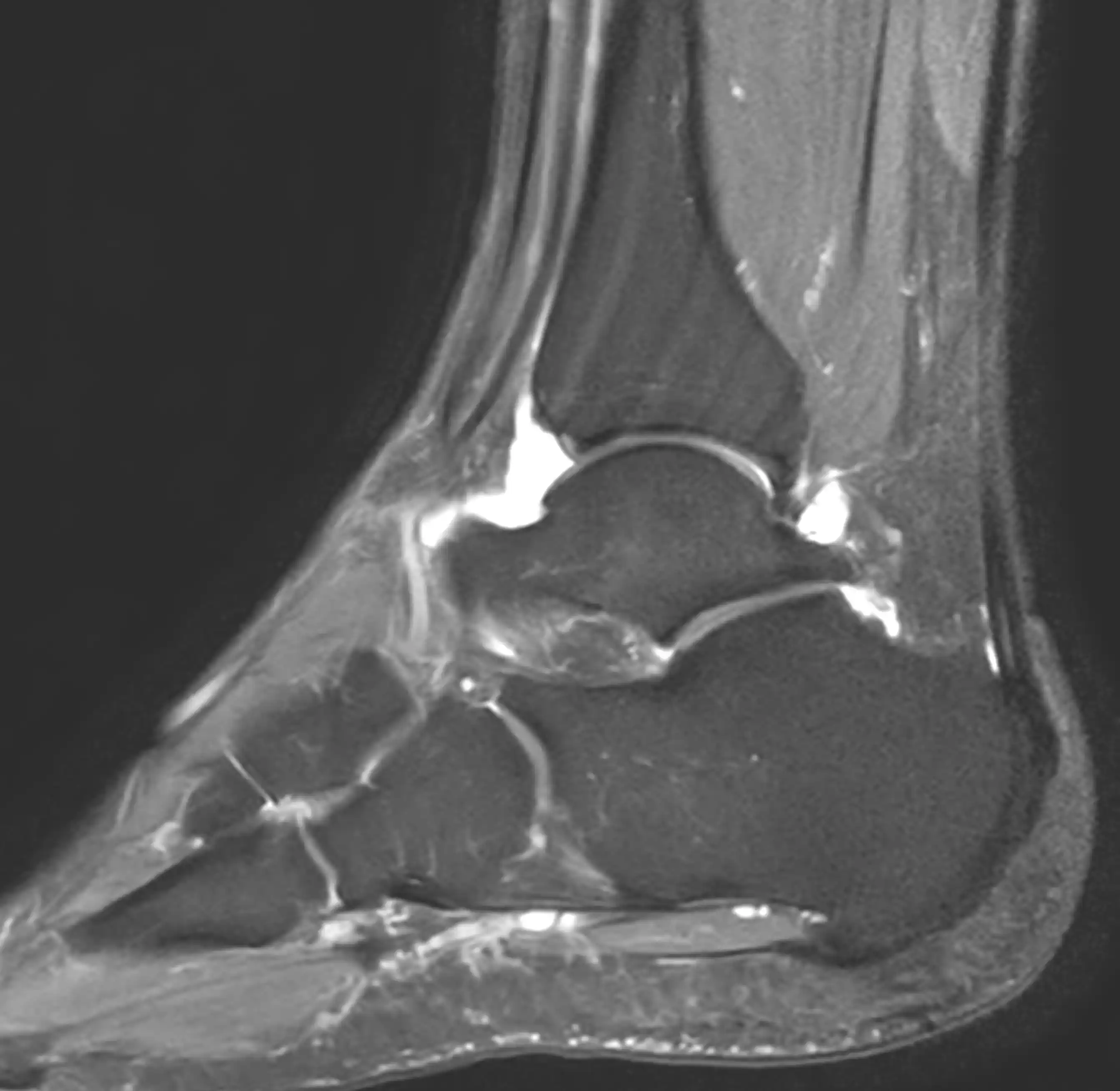 МРТ гомілково-ступневого суглобу
