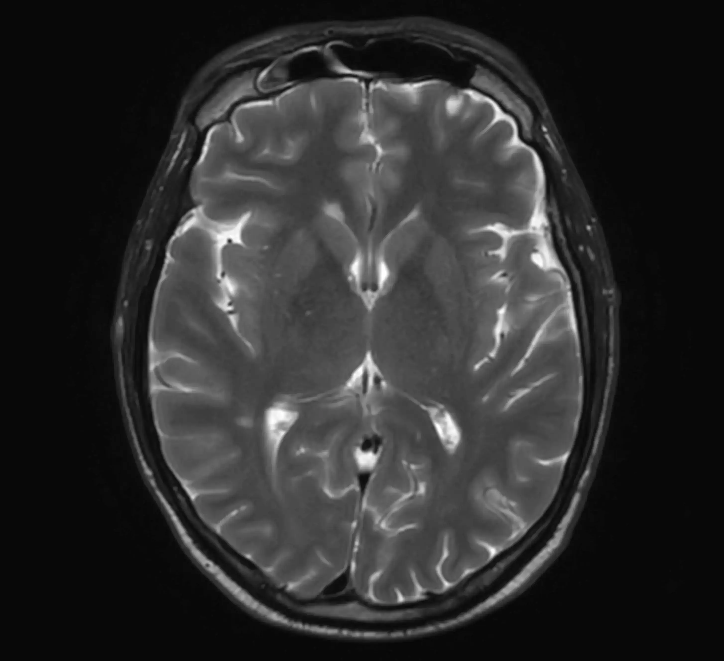 МРТ головного мозку при епілепсії