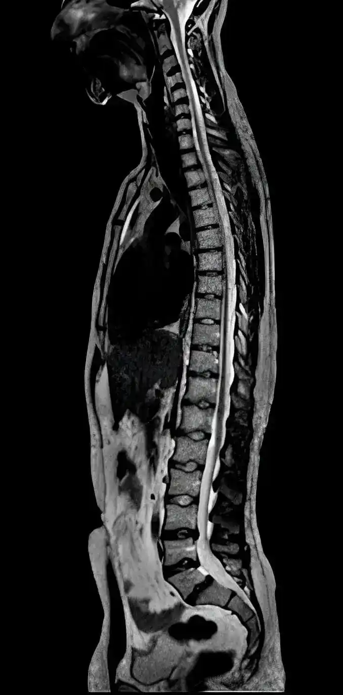 МРТ хребта
