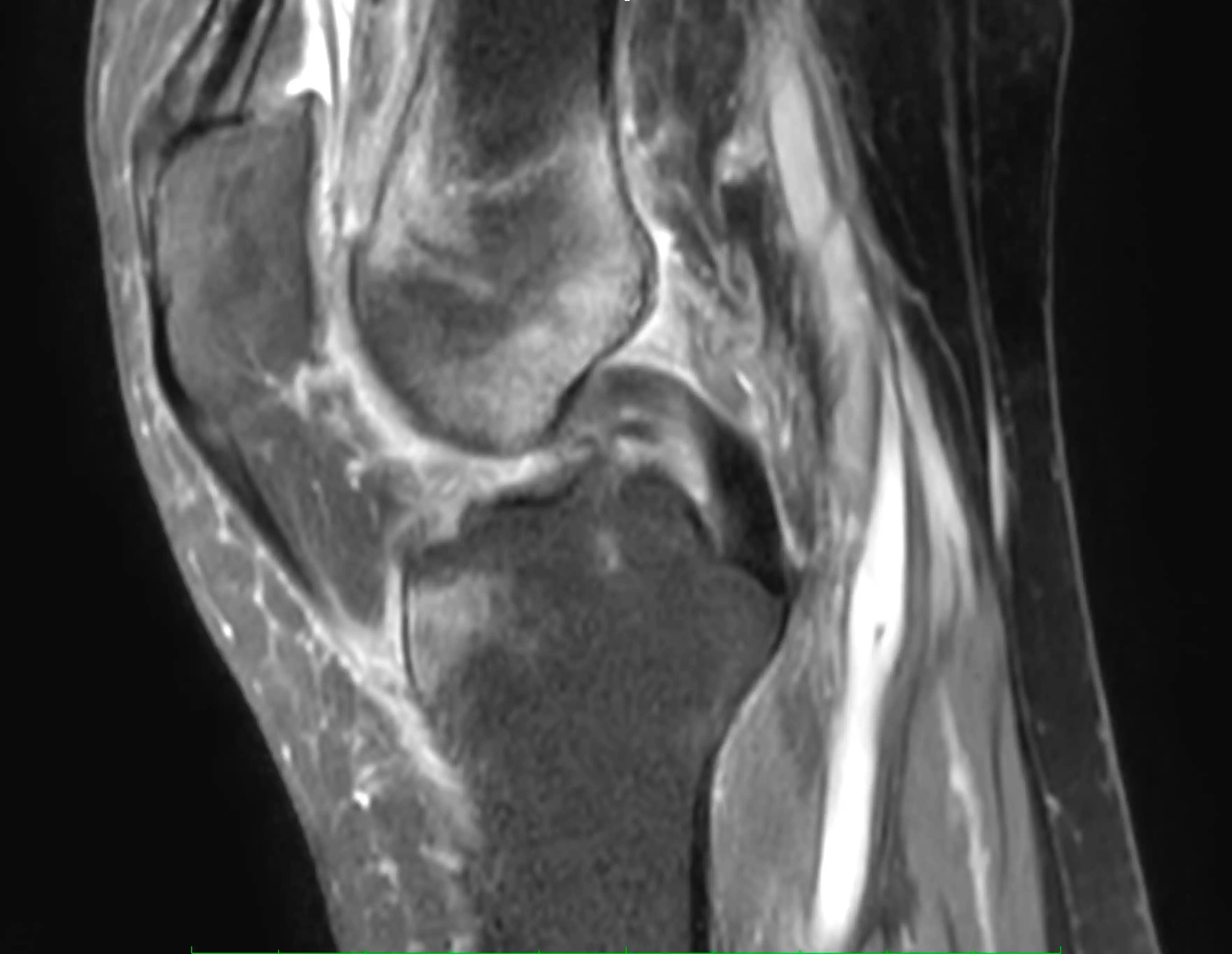 МРТ колінного суглобу