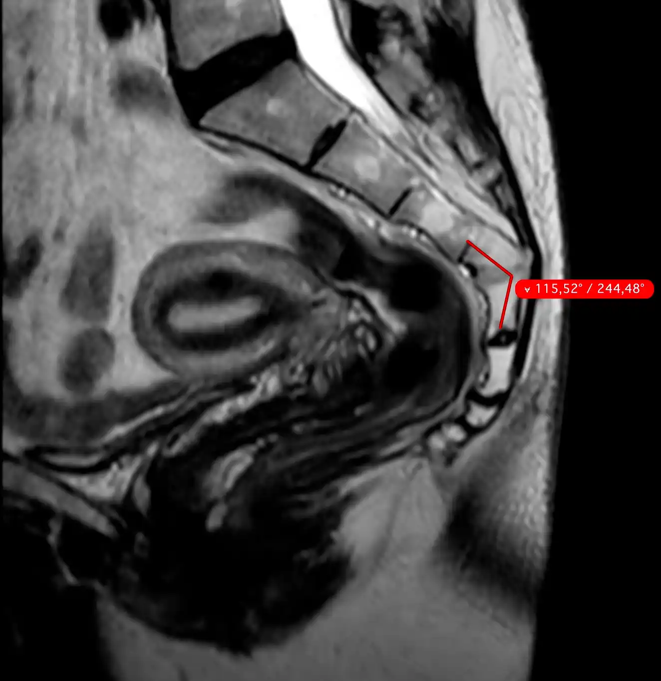 МРТ крижів і куприка