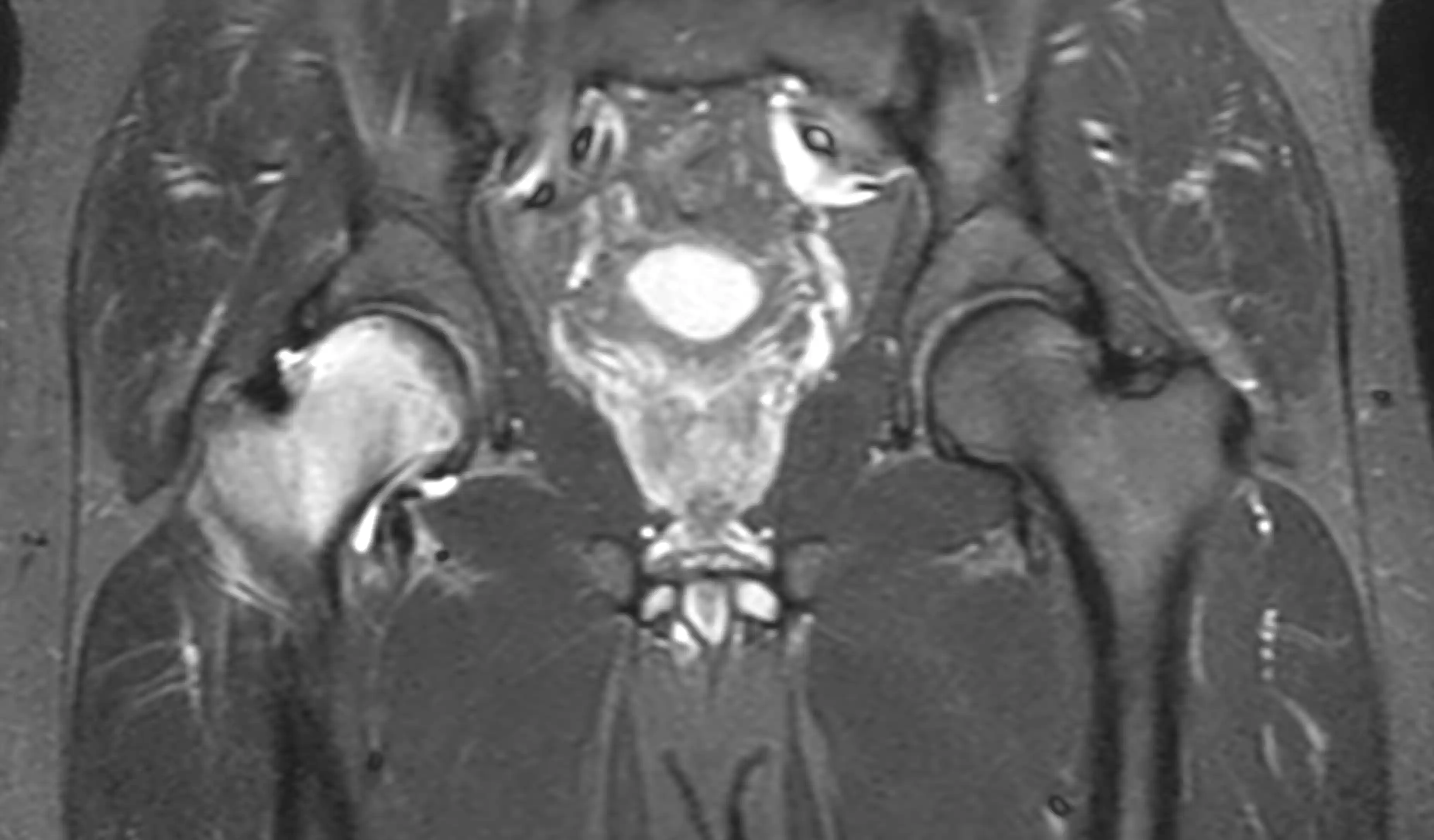 МРТ кульшових суглобів
