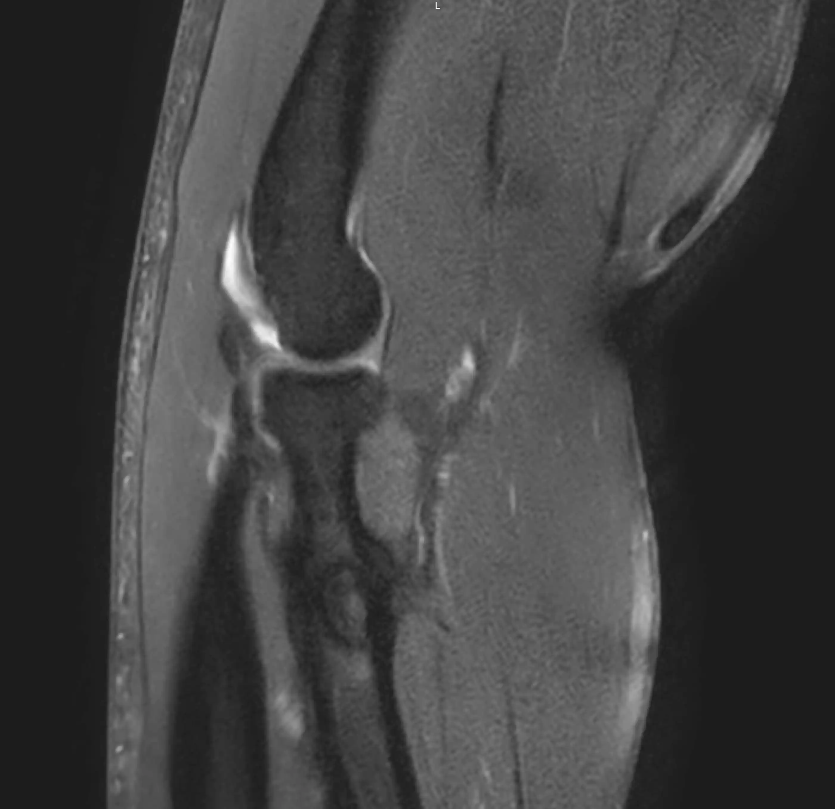 МРТ ліктьового суглобу