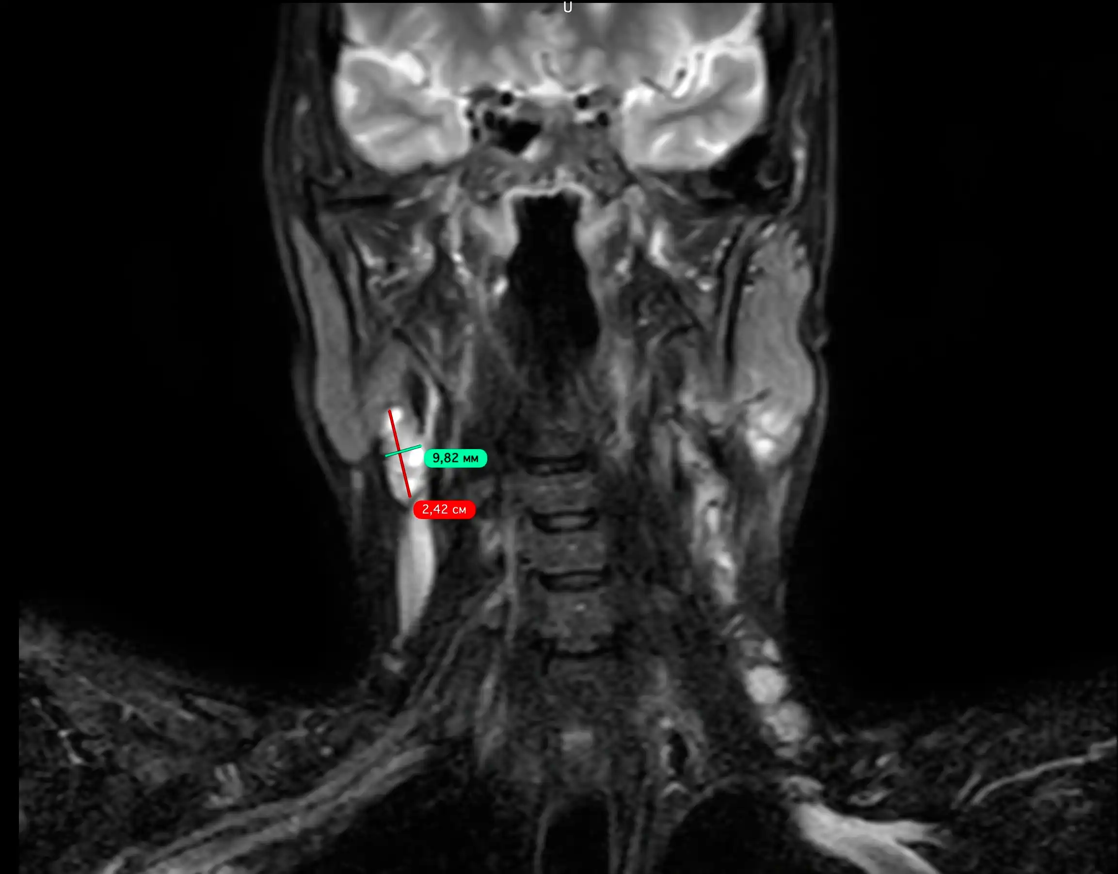 МРТ м'яких тканин шиї