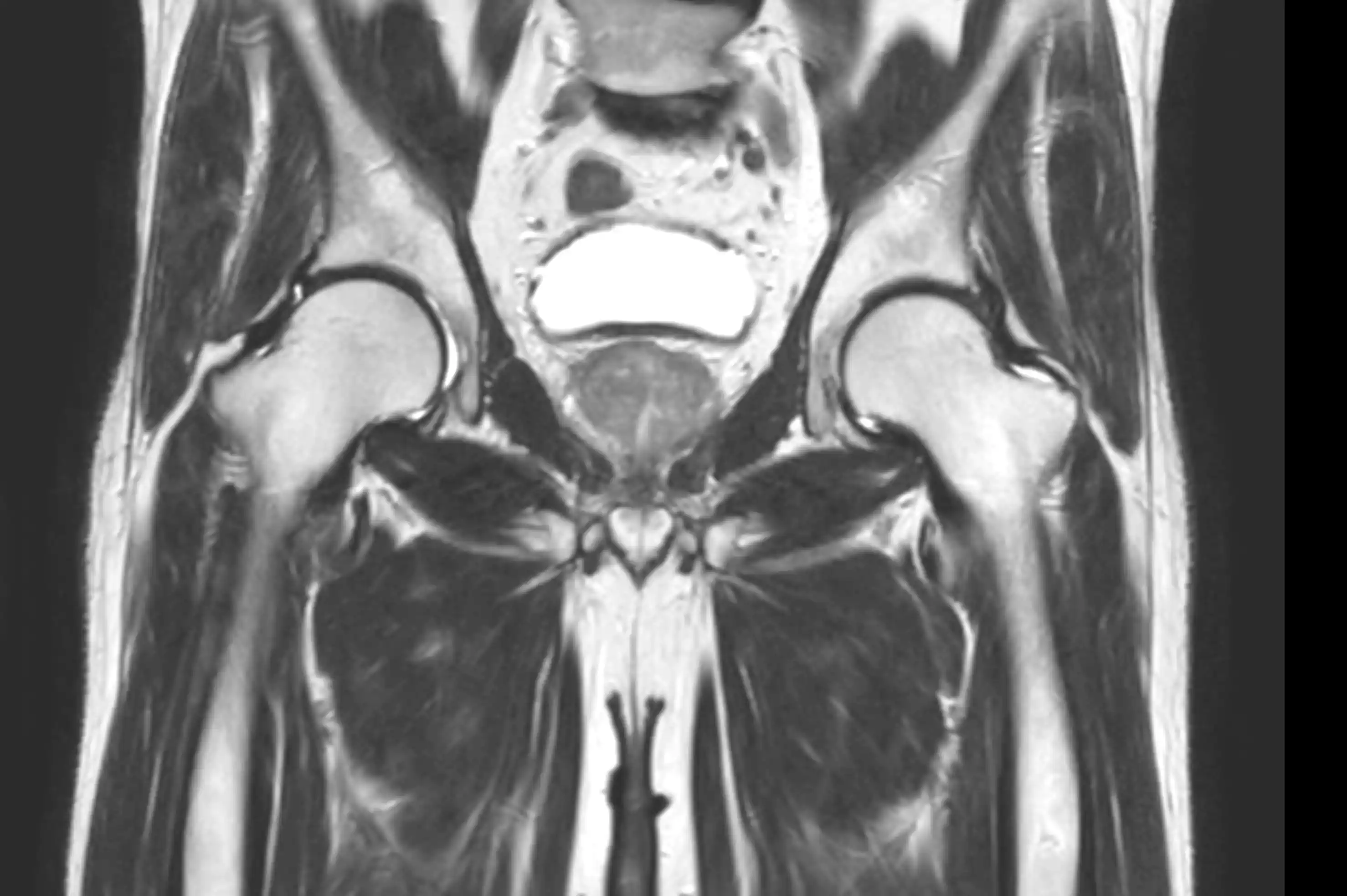МРТ органів малого тазу у чоловіків
