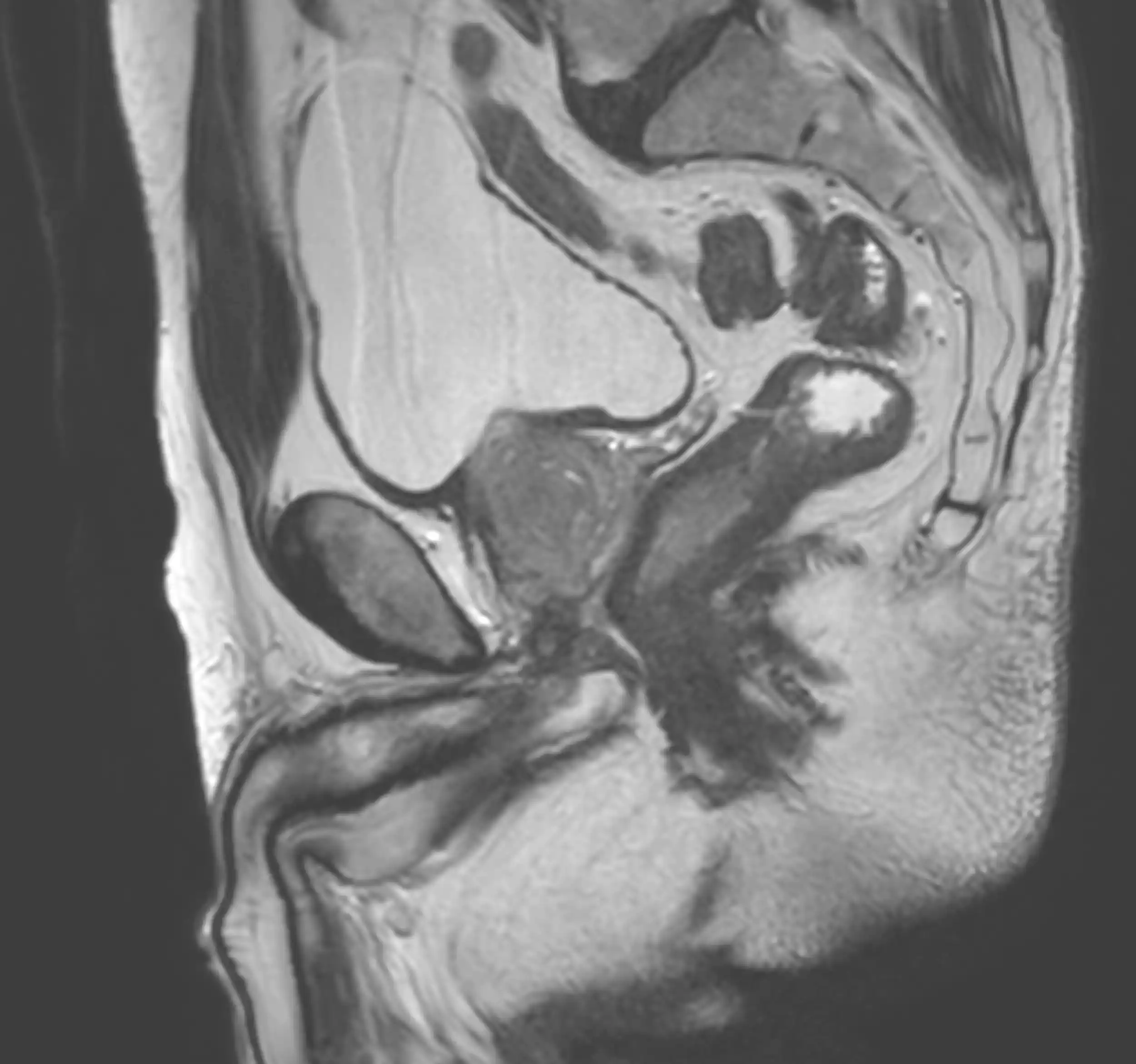 МРТ органів малого тазу у жінок