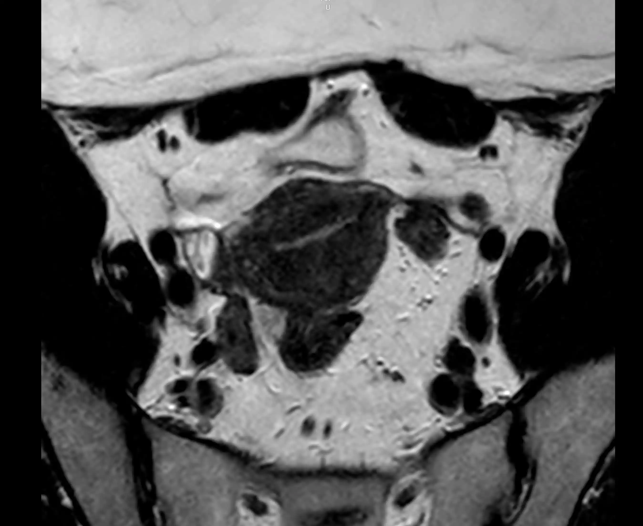 МРТ матки шийки матки