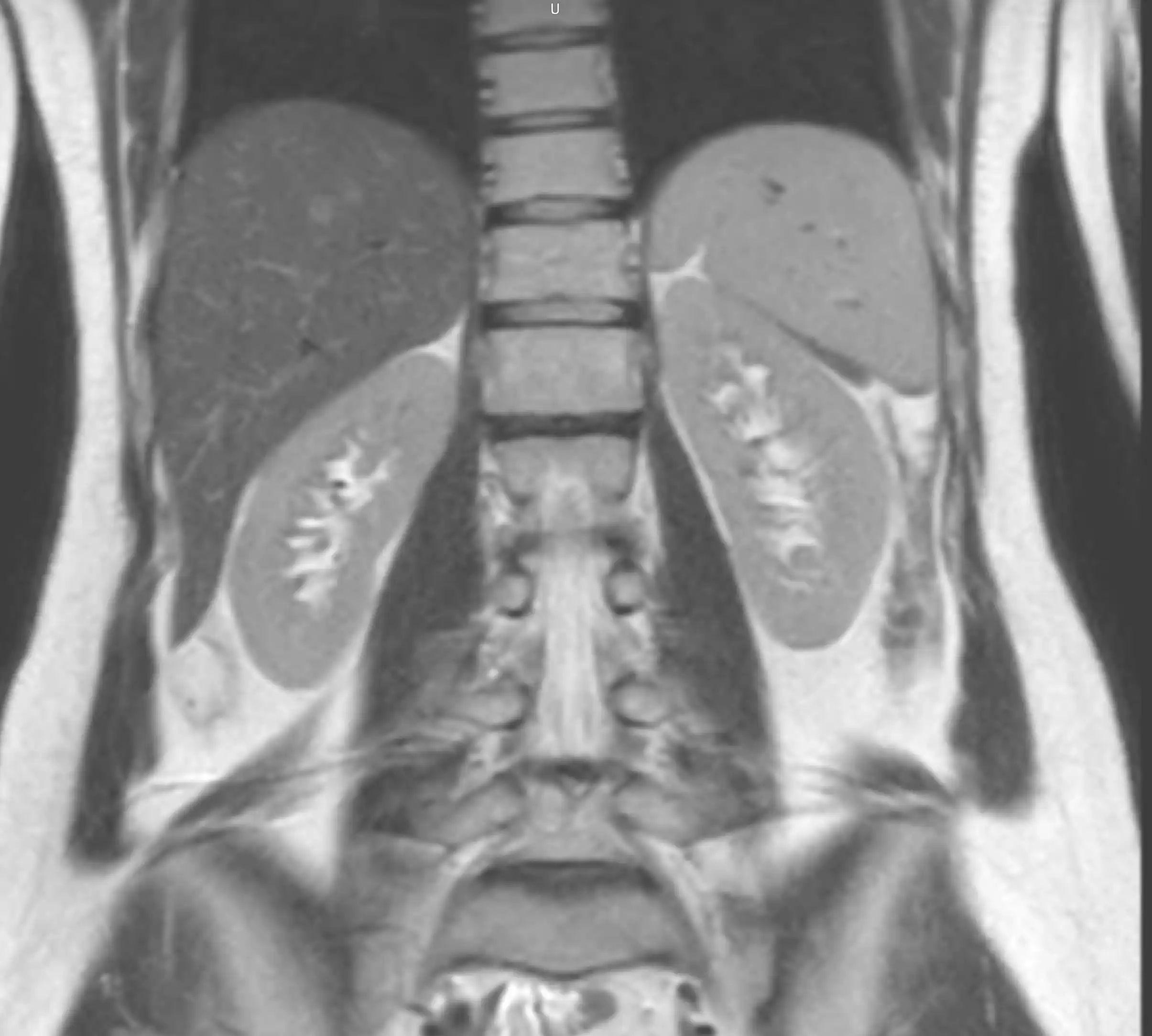 МРТ наднирників