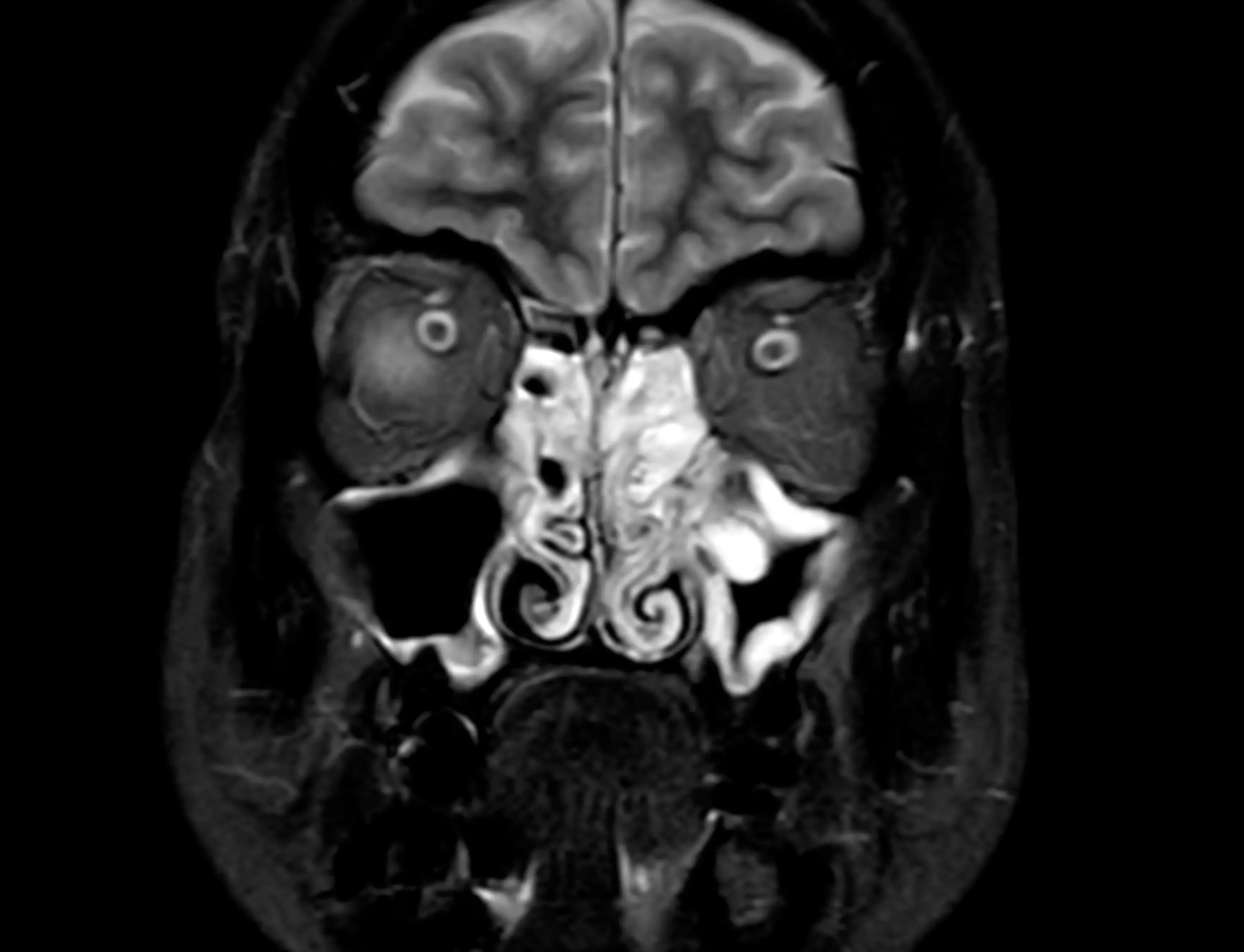 МРТ навколоносових пазух