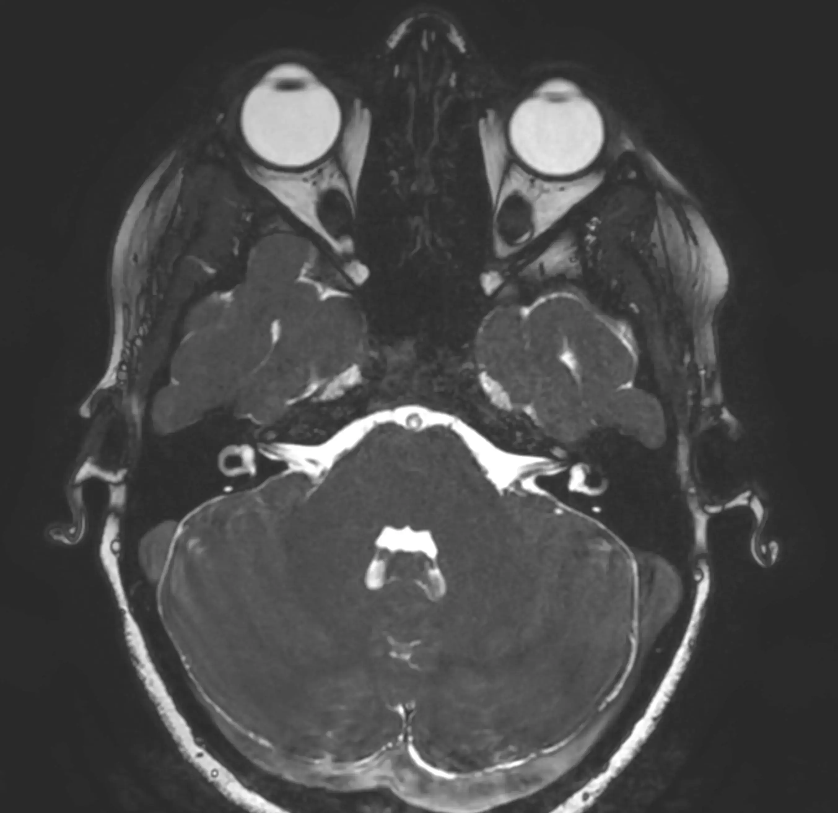 МРТ ока і очних орбіт