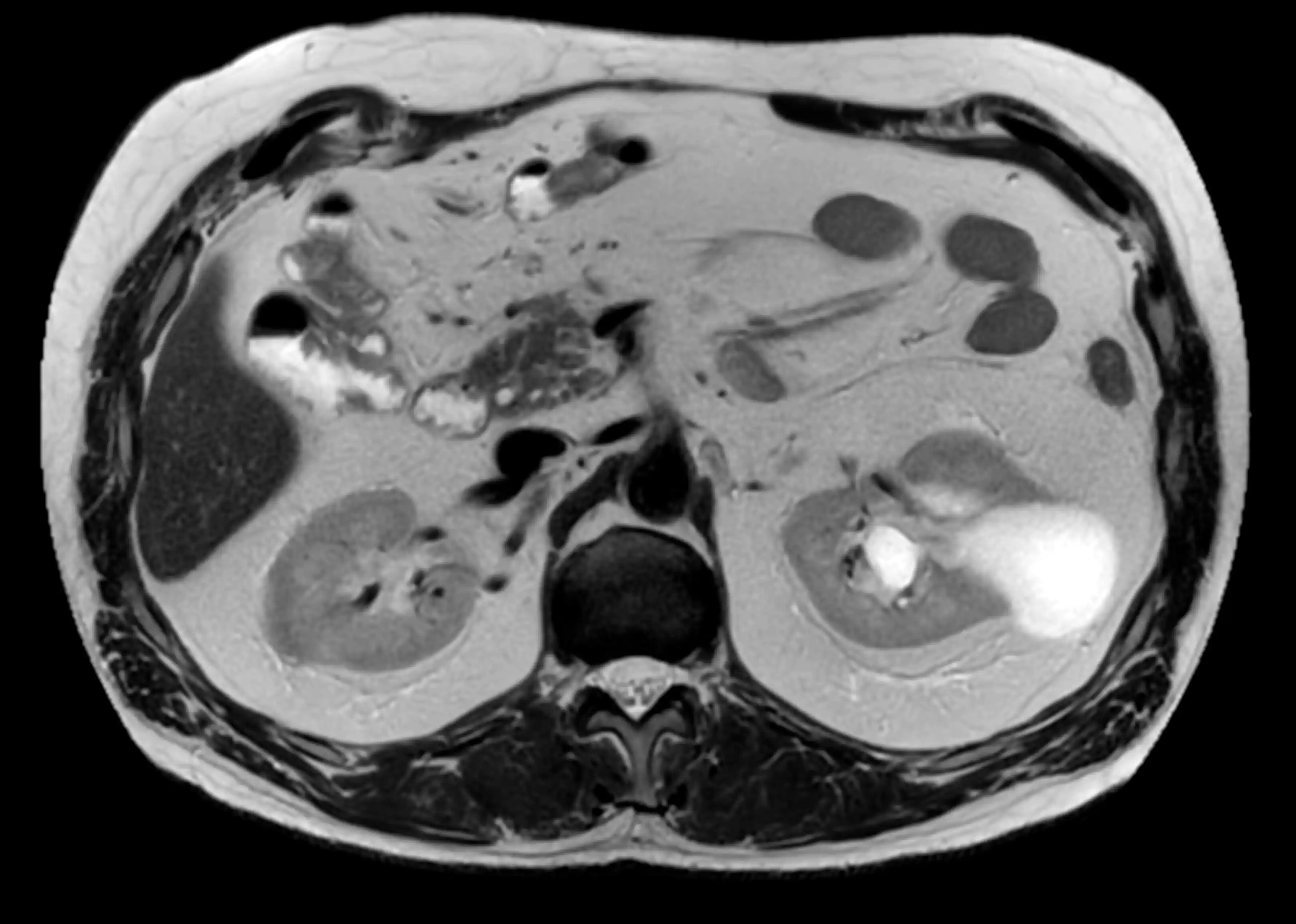 МРТ органів черевної порожнини