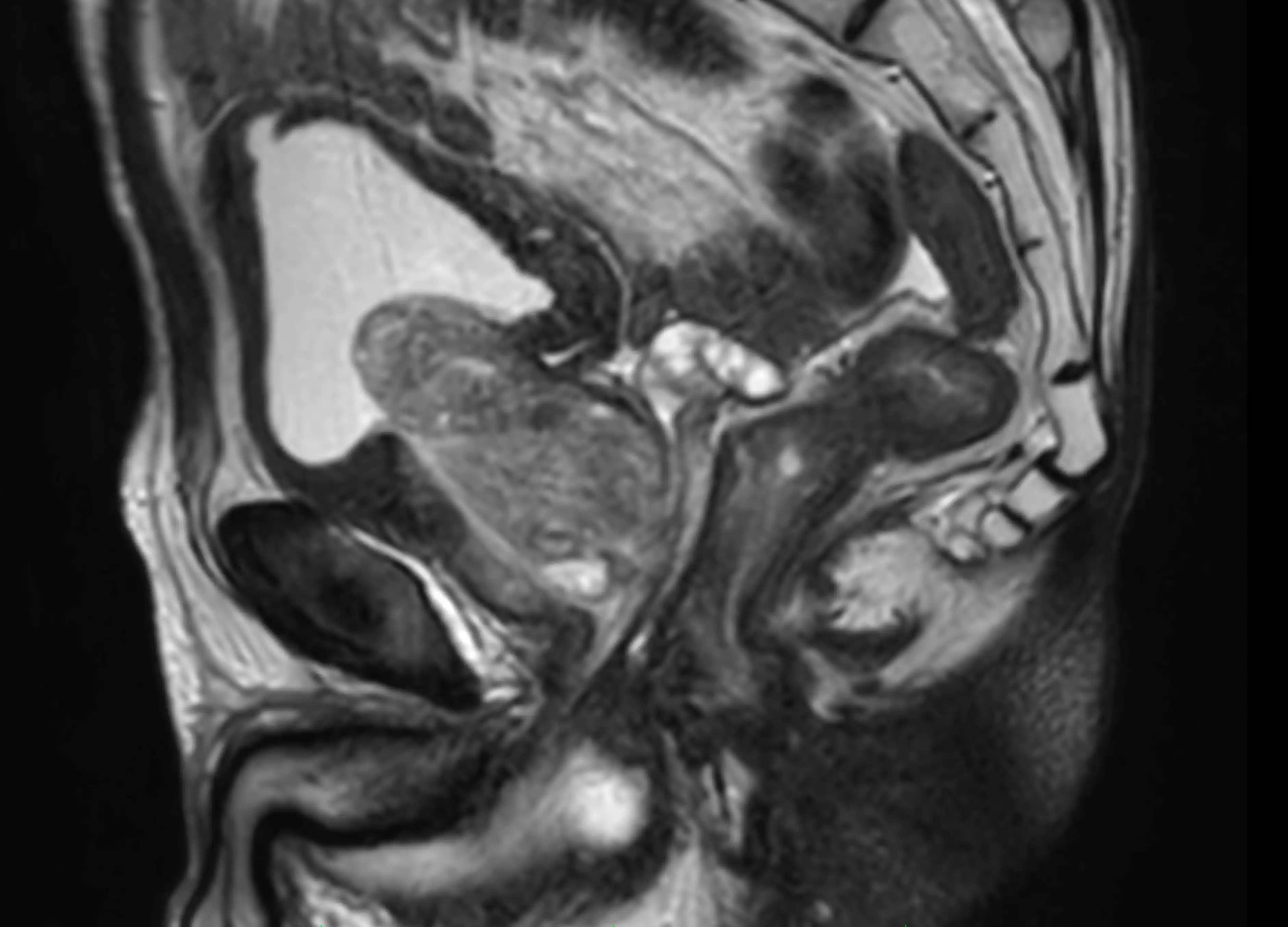 МРТ органів малого тазу