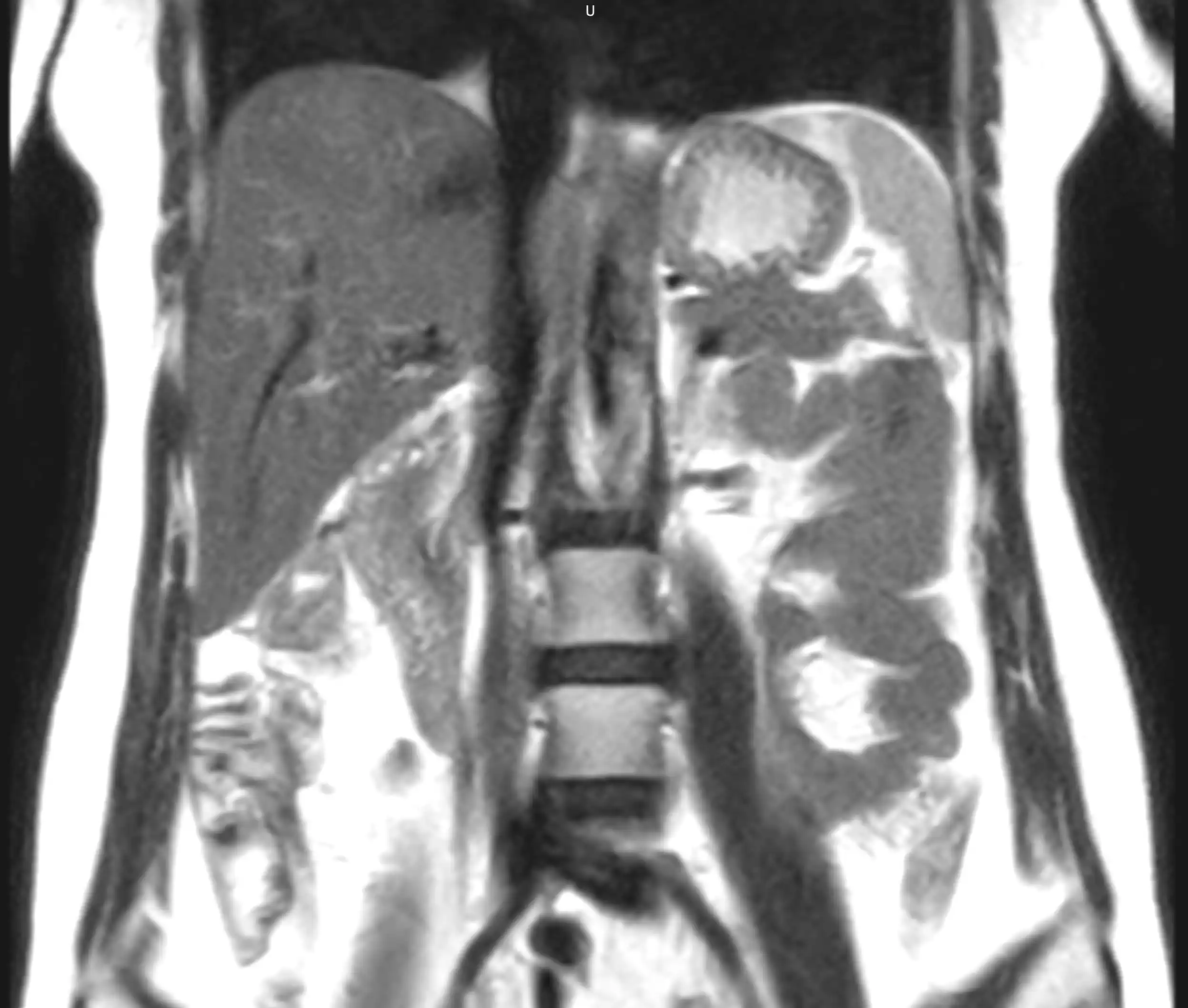 МРТ печінки