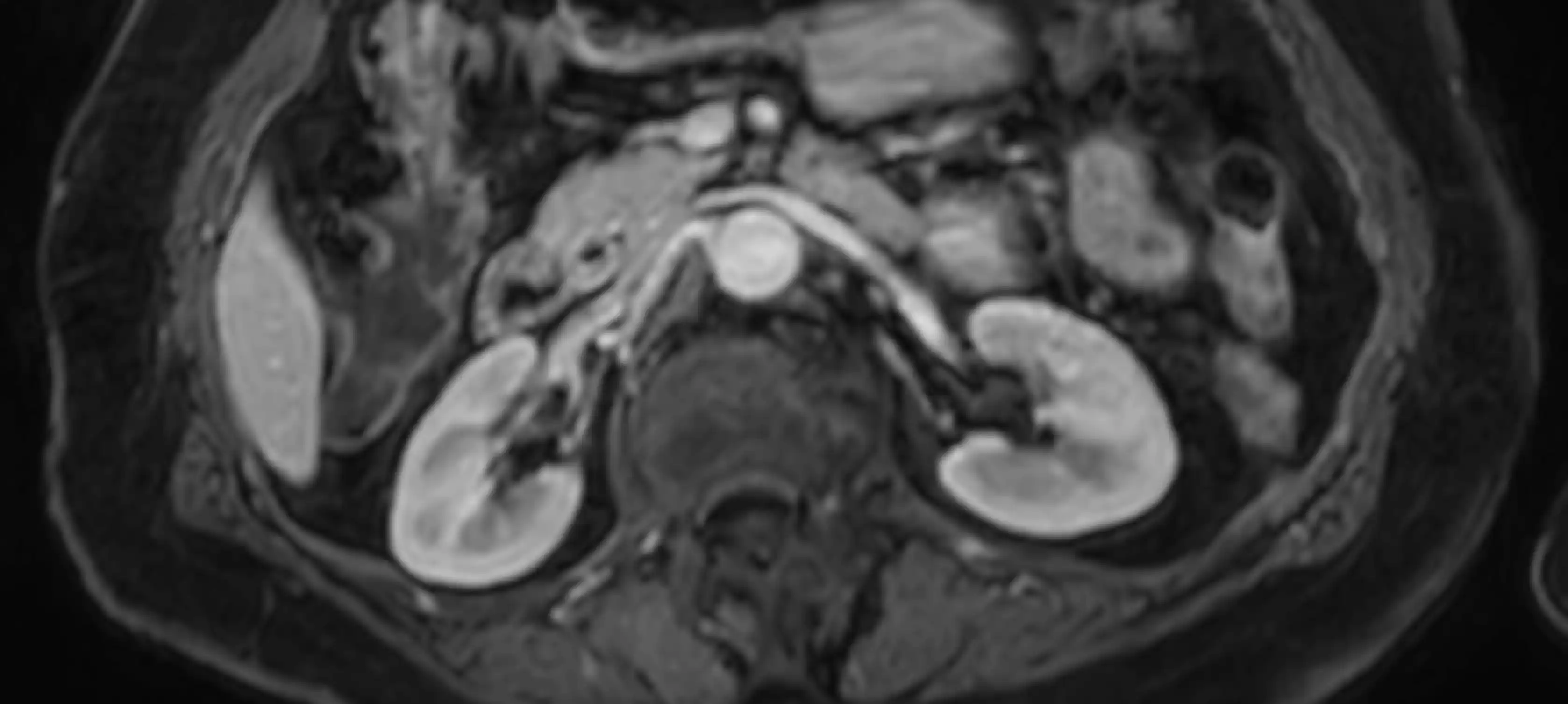 МРТ підшлункової залози