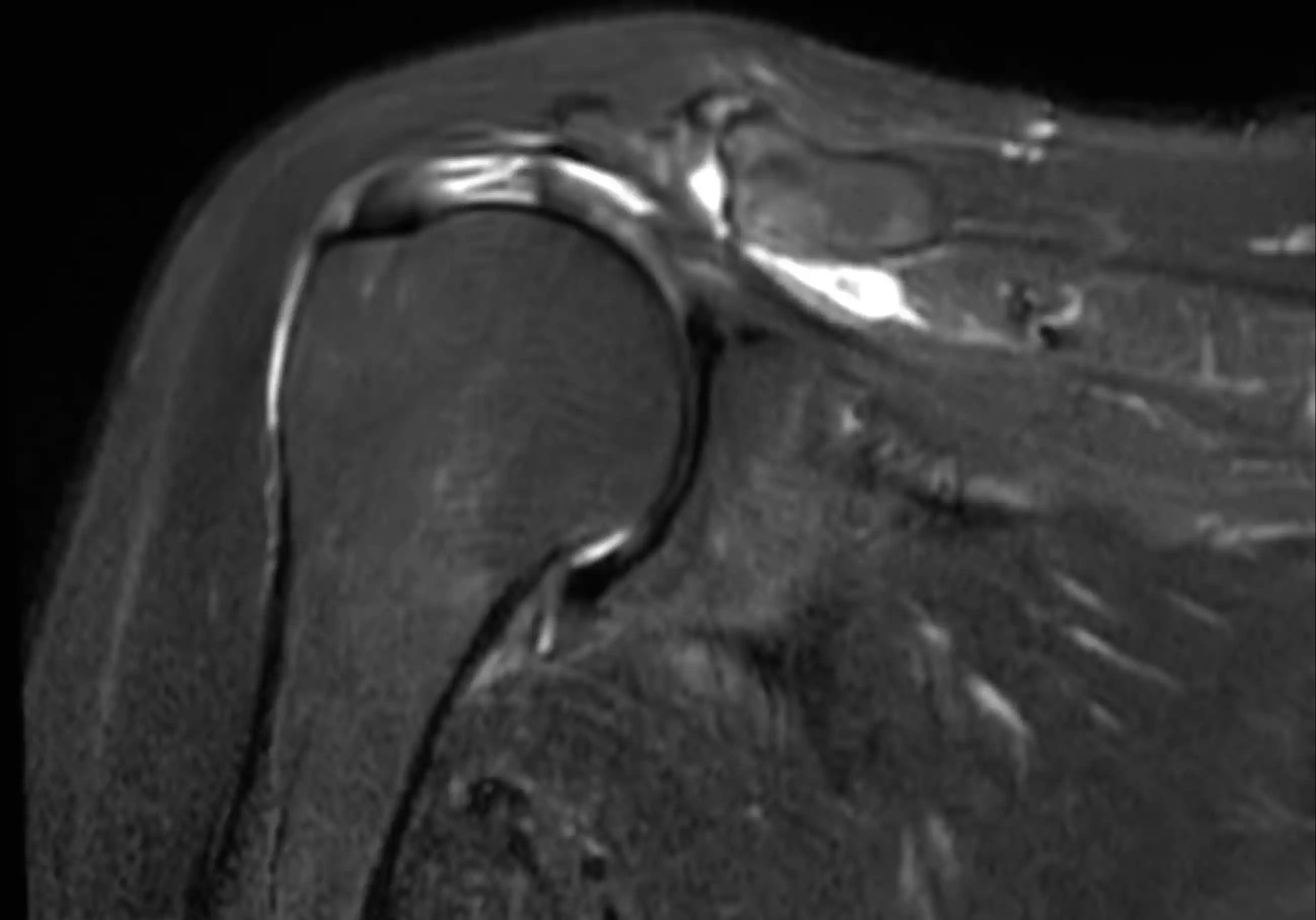 МРТ плечового суглобу