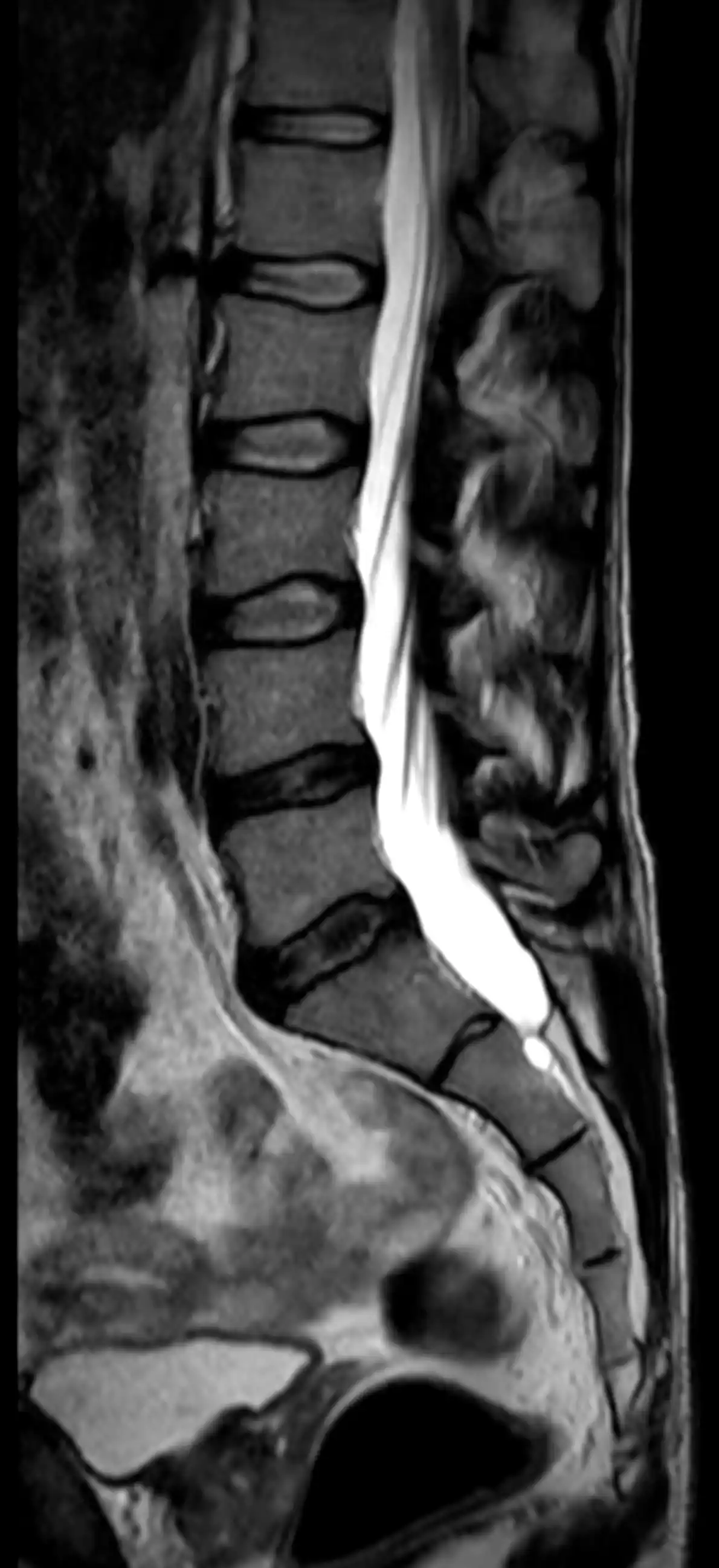 МРТ попереково-крижового відділу хребта