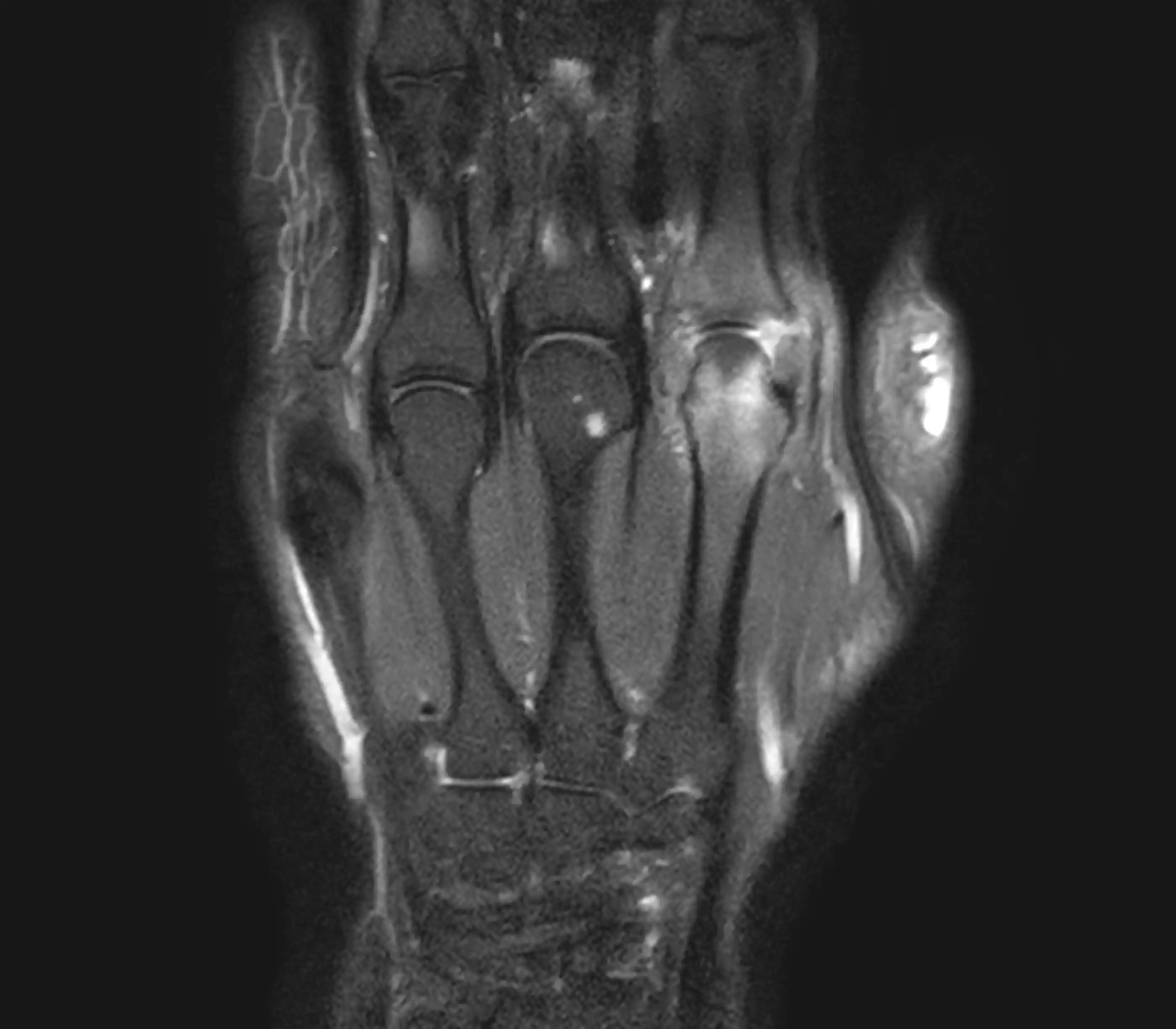 МРТ променезап’ясткового суглобу