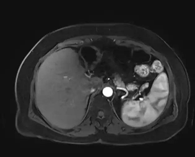 МРТ селезінки