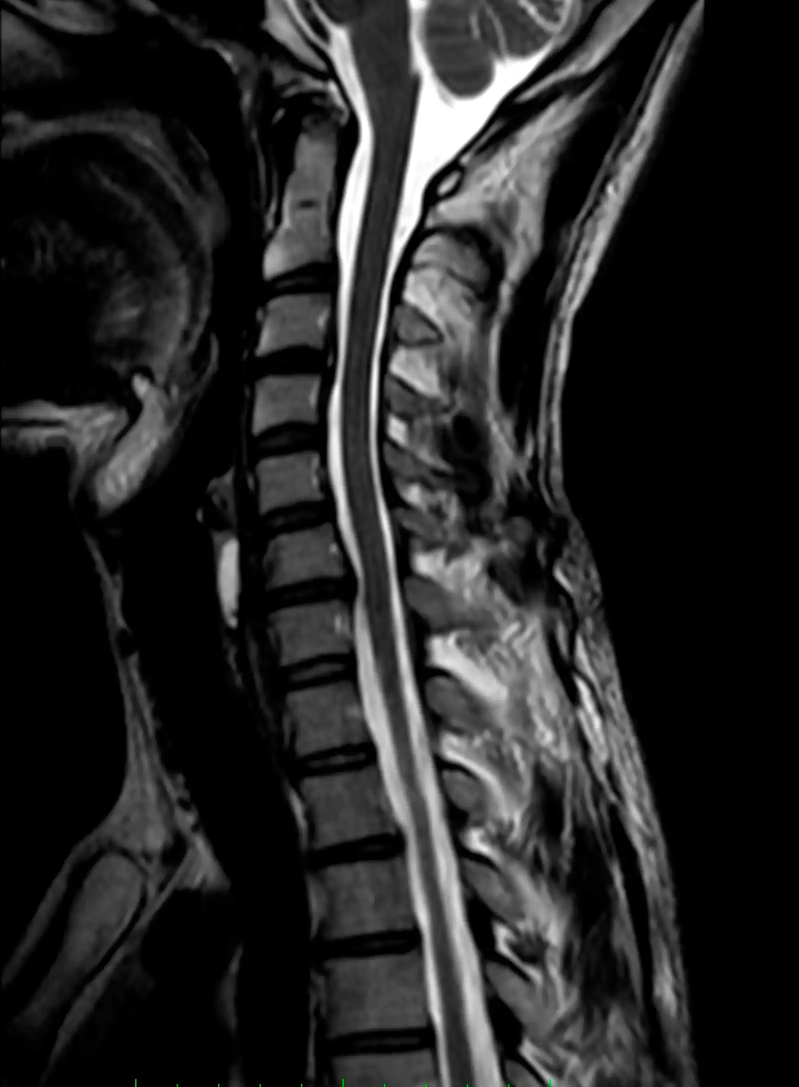 МРТ шийного відділу хребта