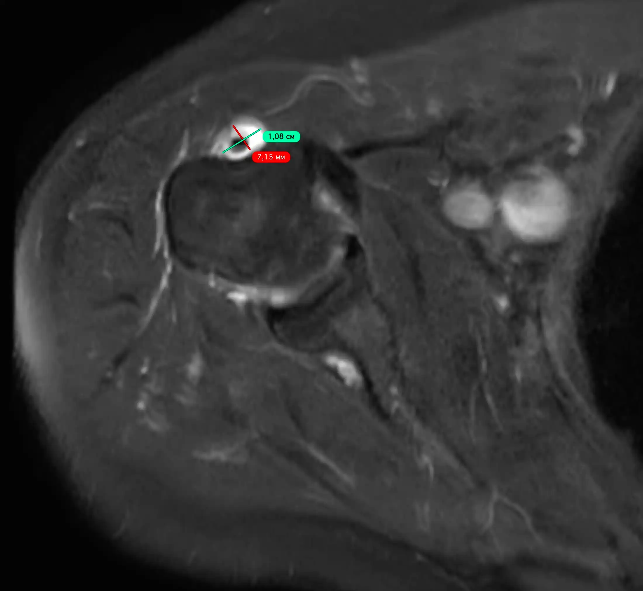 МРТ суглобів