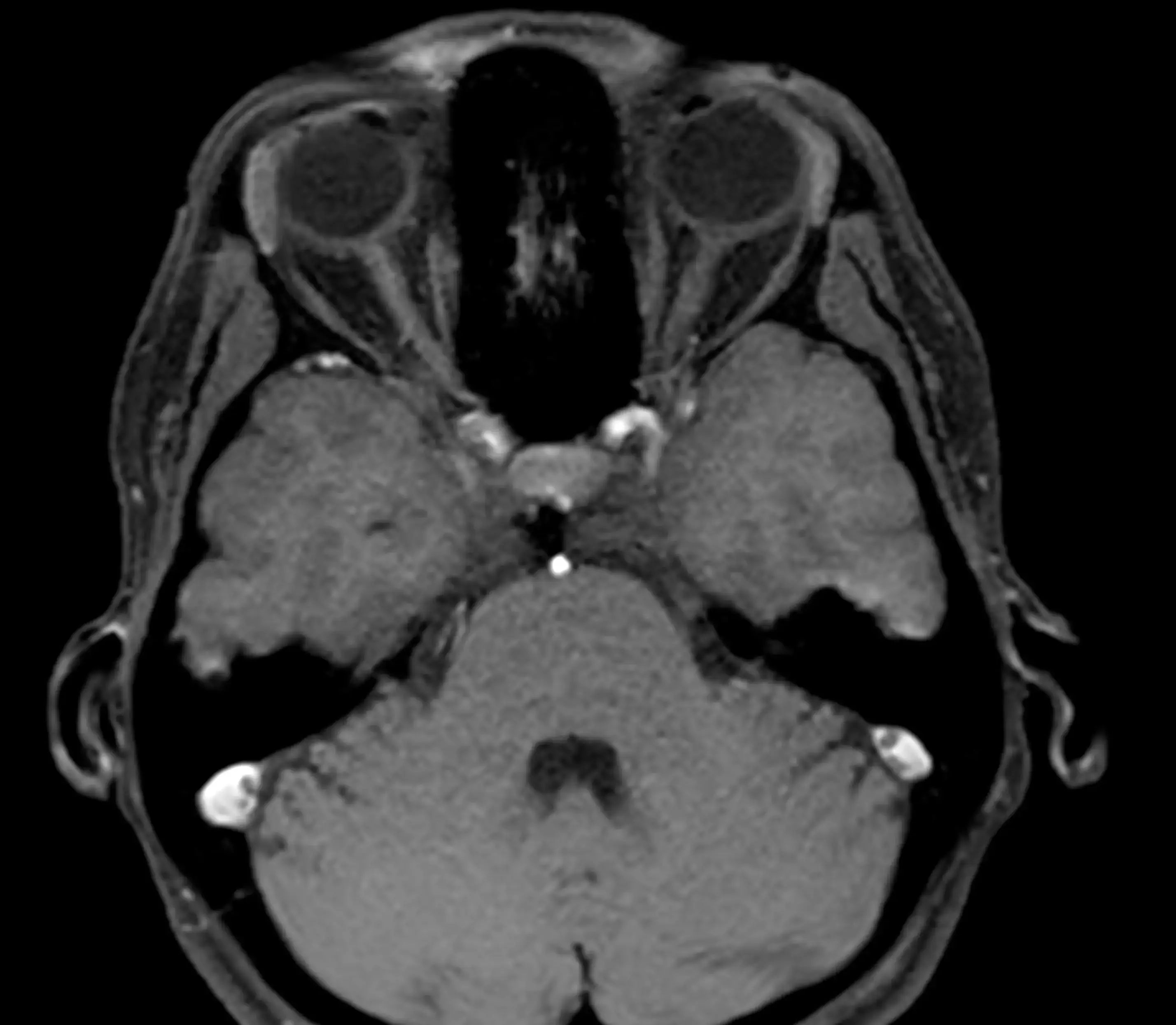 МРТ внутрішнього вуха