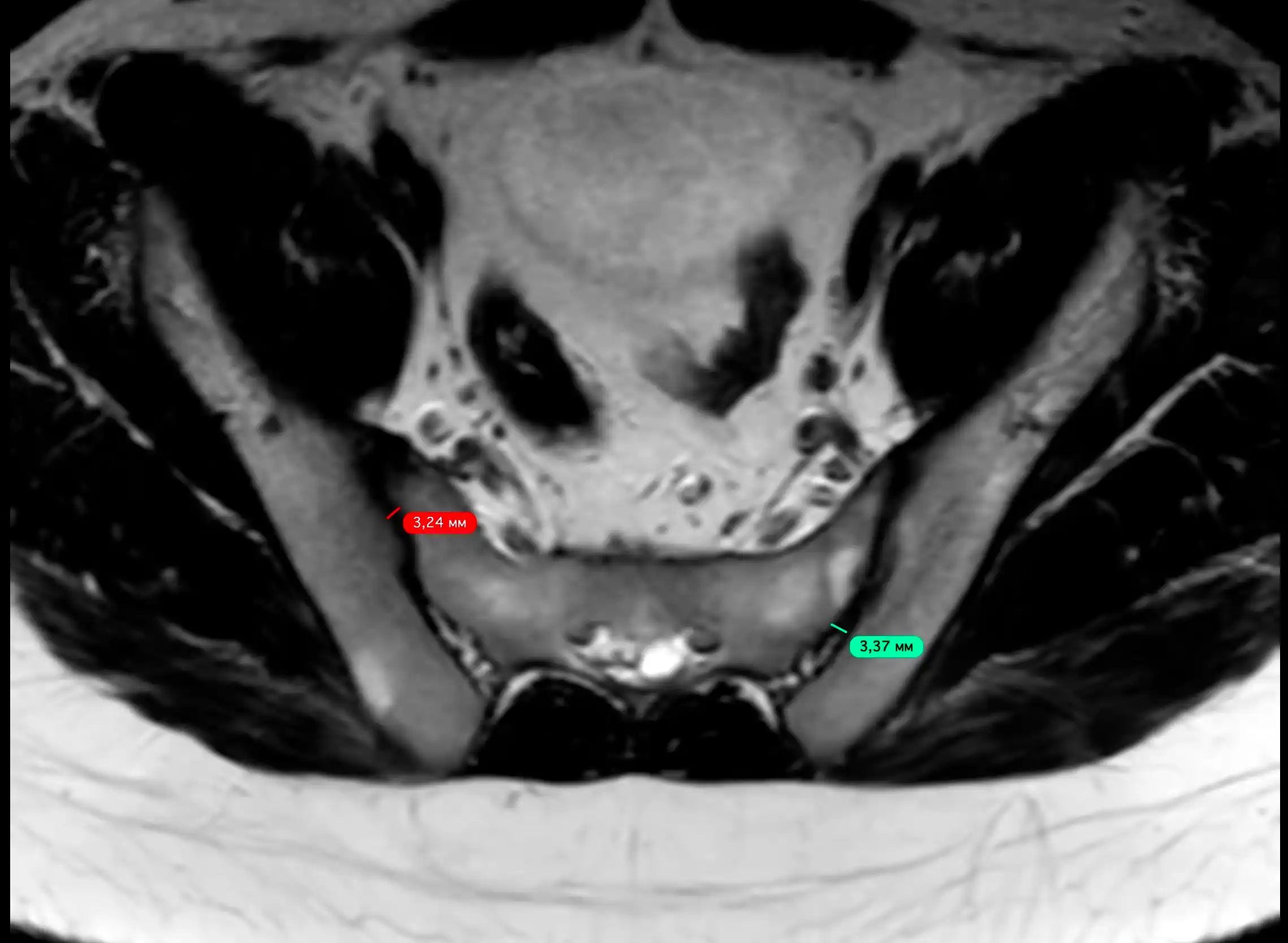 МРТ здухвинно-крижових сполучень